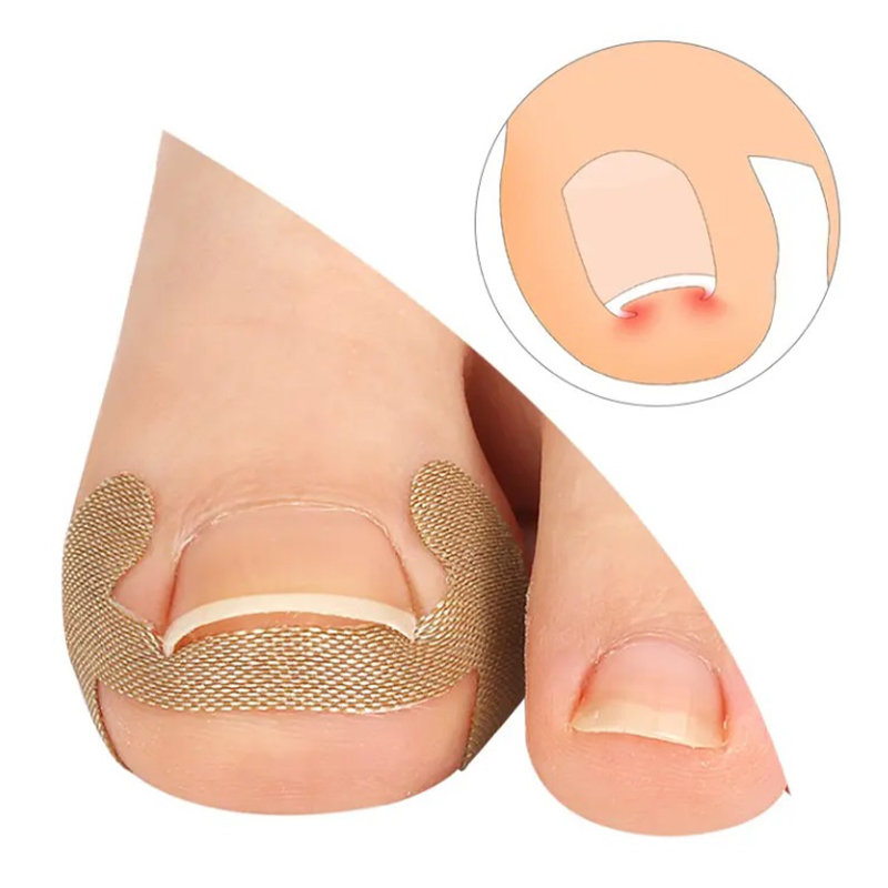 Antimicrobial Soothing Pain Paronychia Correction Nail Stickers
